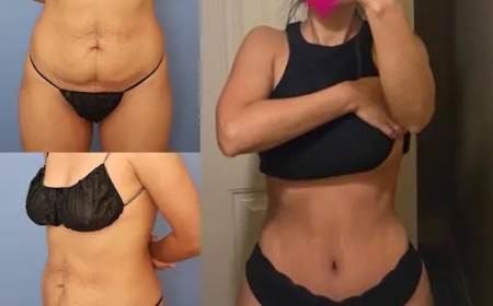 The Best Tummy Tuck Surgeons in dubai: How They Customize Every Procedure for You