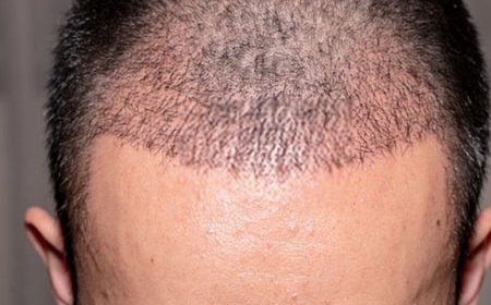 Hair Transplant Bhubaneswar: A New Era of Confidence and Style