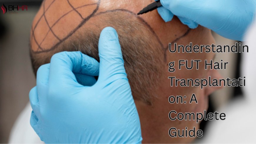 Understanding FUT Hair Transplantation: A Complete Guide