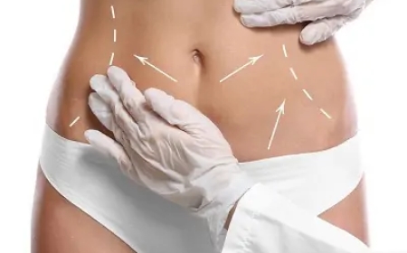 The Role of Liposuction in Body Contouring: Expert Insights on Liposuction cost in Dubai