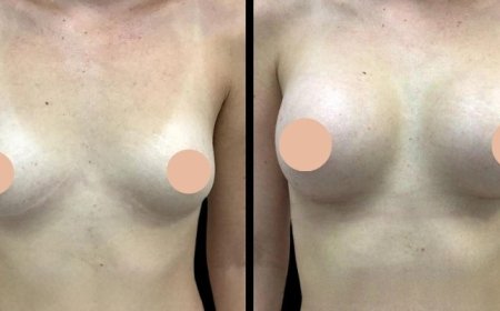 The Benefits of Breast Augmentation Surgery in Dubai: A Confidence Boost