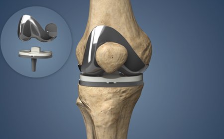 Best Knee Replacement Surgery in Delhi: Trust Dr. Nikhil Verma for Life-Changing Results