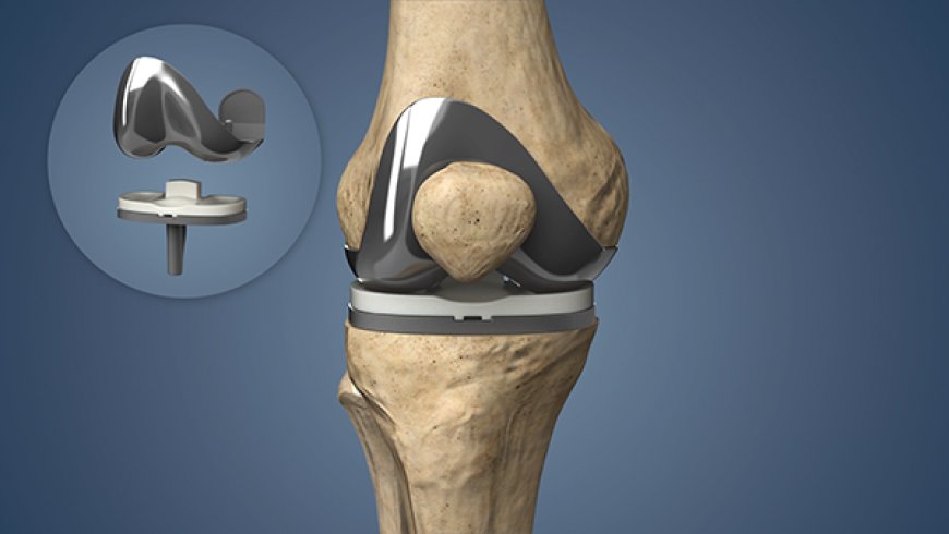 Best Knee Replacement Surgery in Delhi: Trust Dr. Nikhil Verma for Life-Changing Results